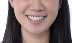 矯正後，讚爛笑容最後一哩路---全瓷冠貼片修復