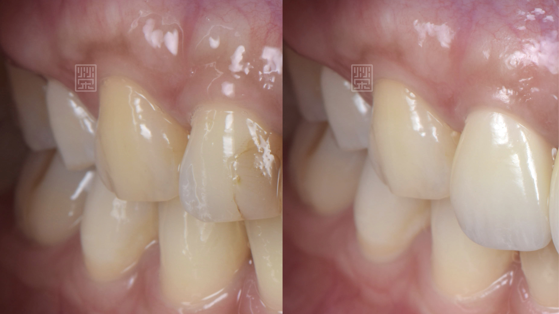美白後，犬齒提升亮白顏色
