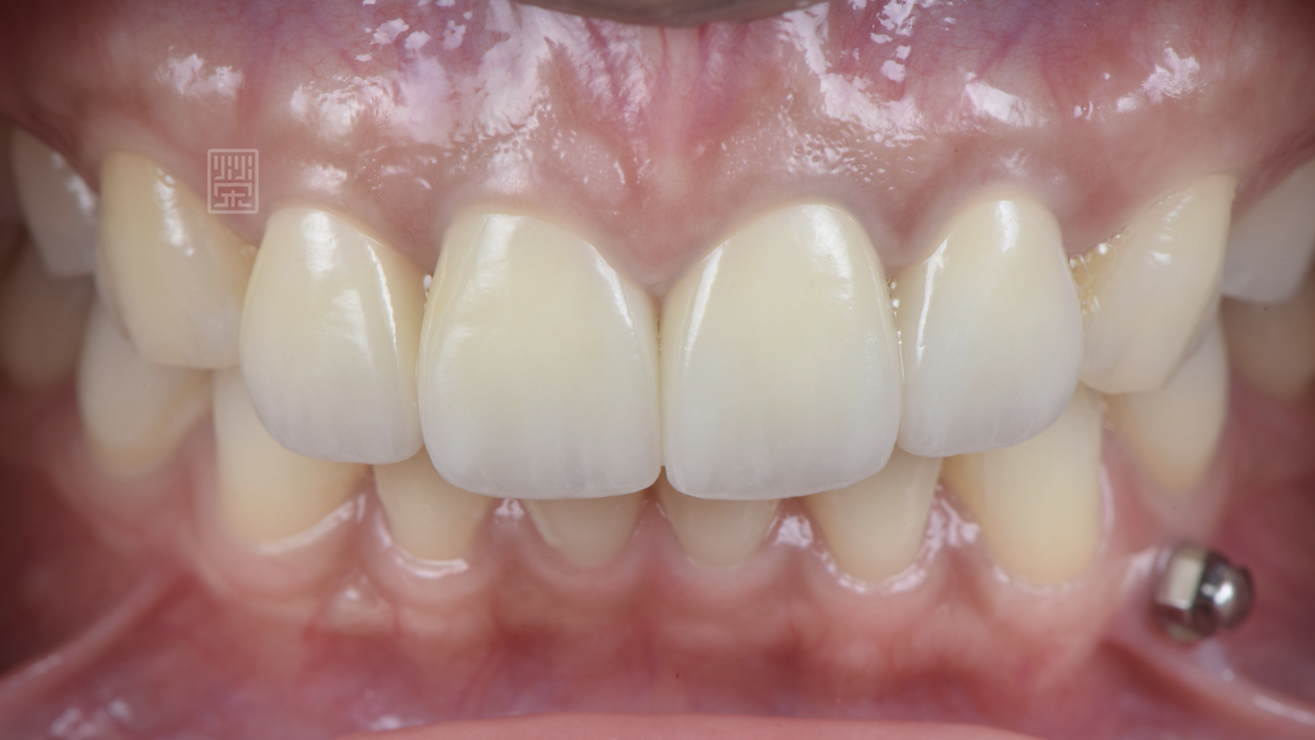 全瓷冠貼片完成