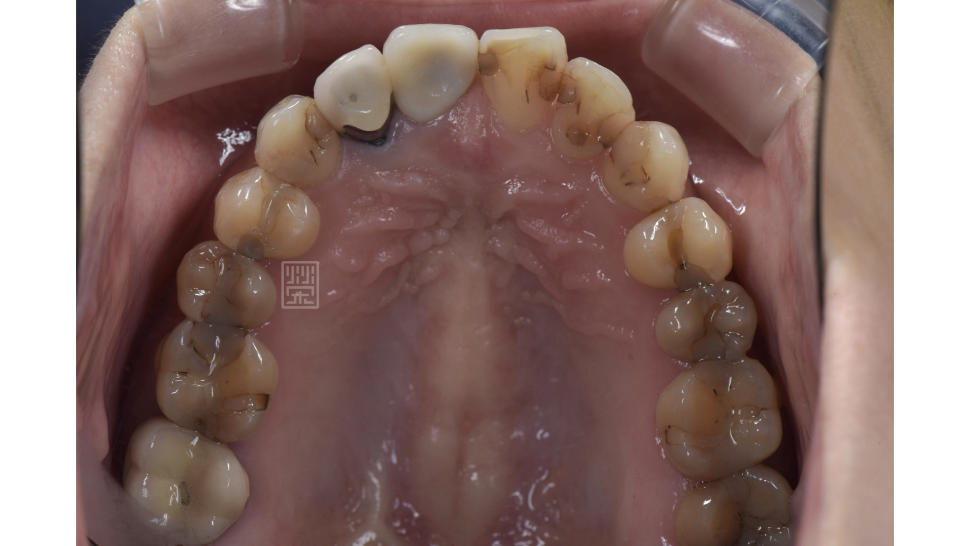 上顎後牙多處蛀牙