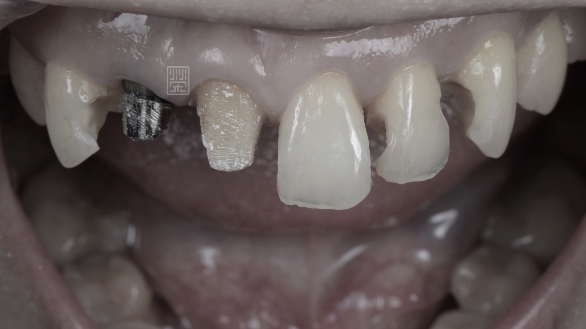 前牙蛀牙清除後齒質受損嚴重