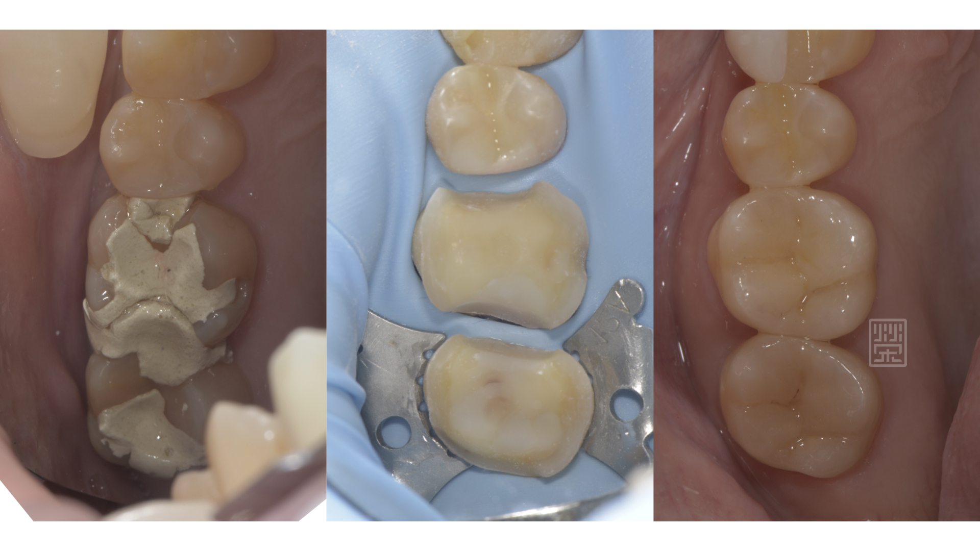 後牙全瓷嵌體修復