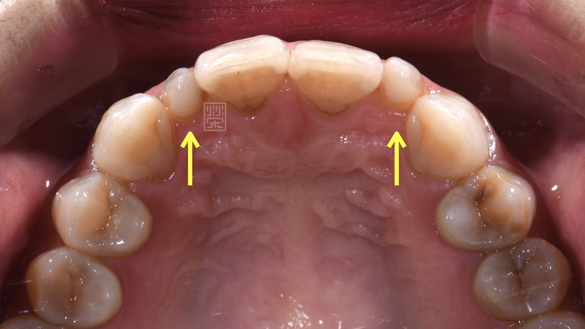 側門牙錐狀牙，明顯比旁邊牙齒小