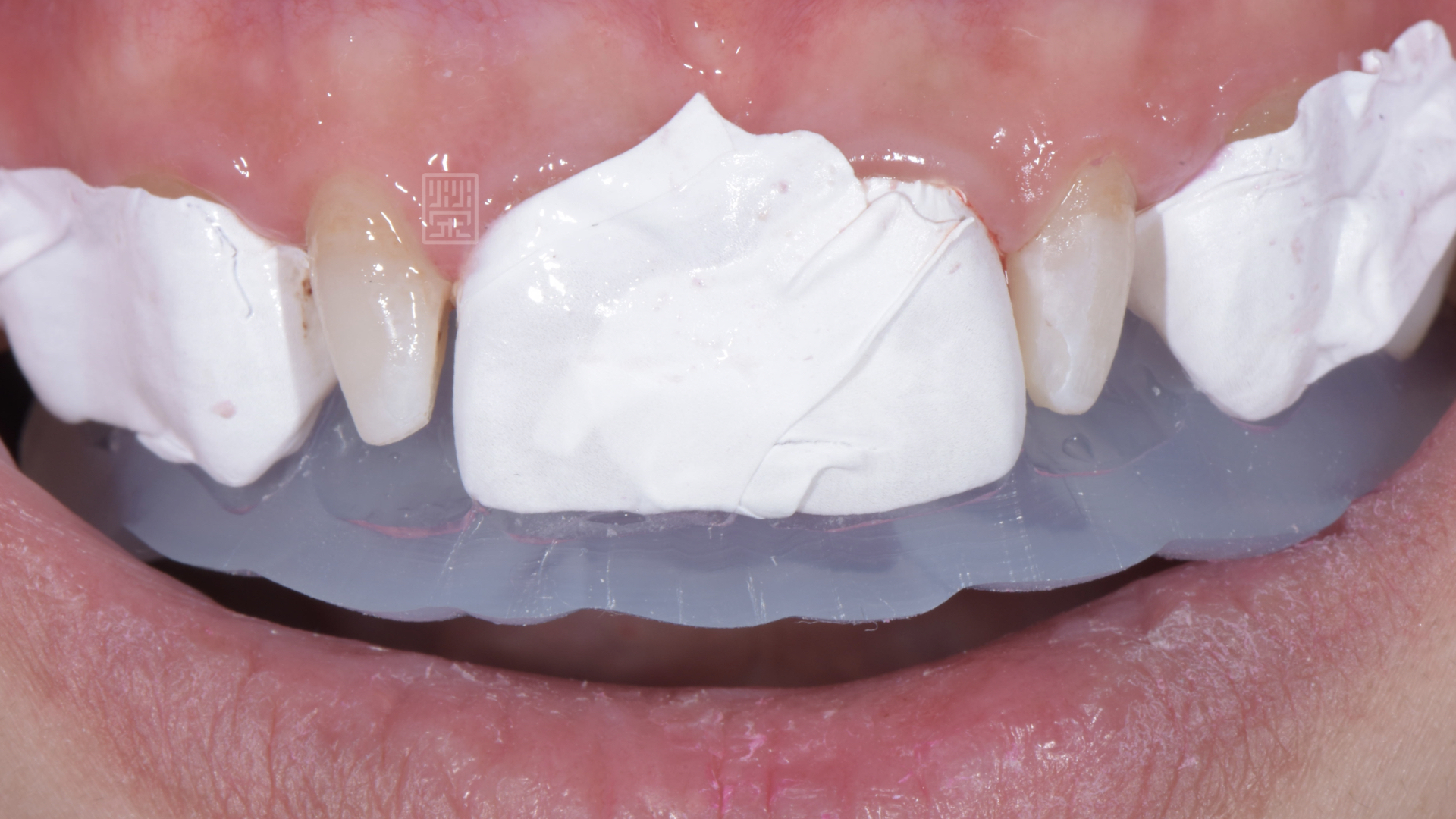 臨牙保護後，準備復形側門牙