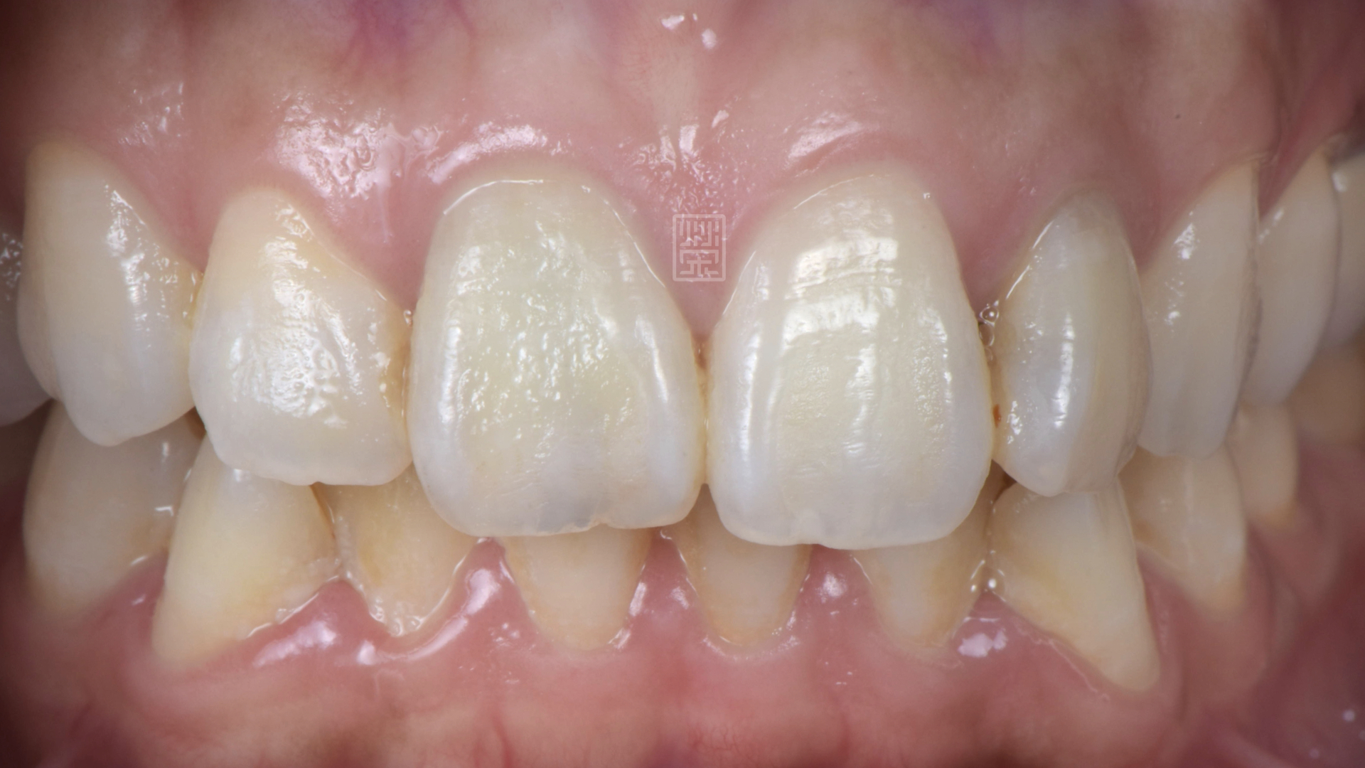 根管治療後牙齒變黑