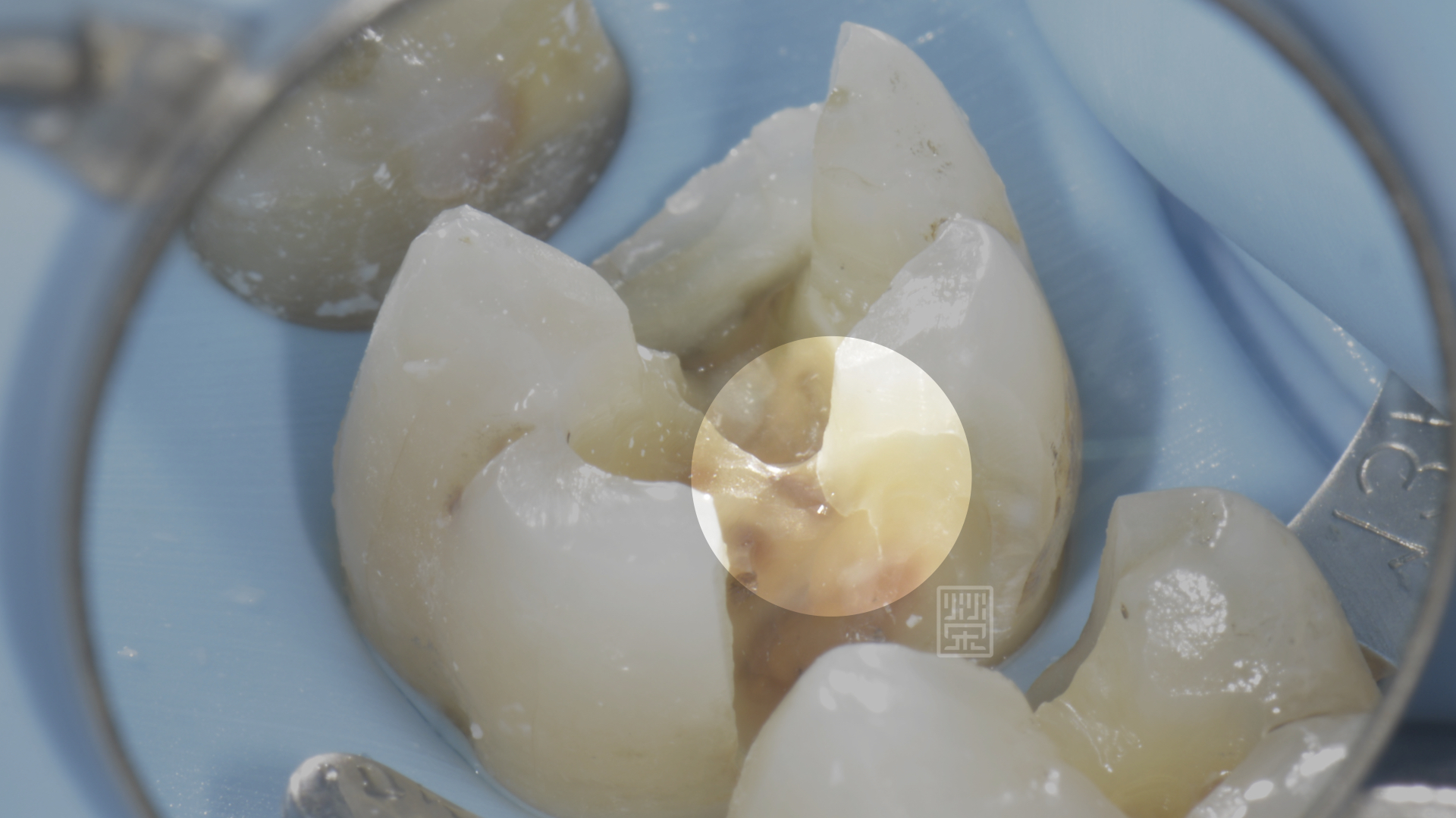 牙齒窩洞交接處有裂痕