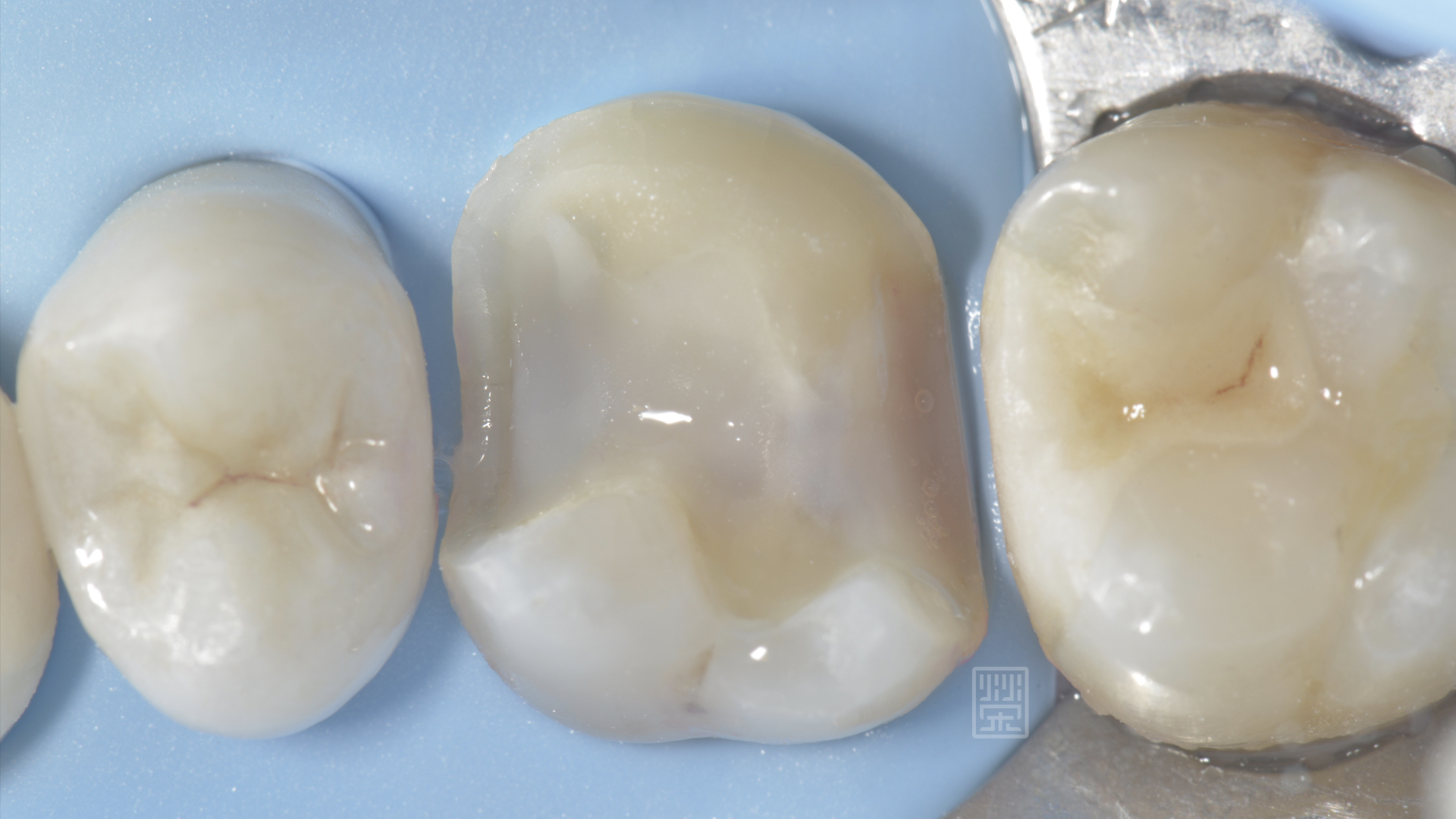 將有裂痕的牙齒包覆起來