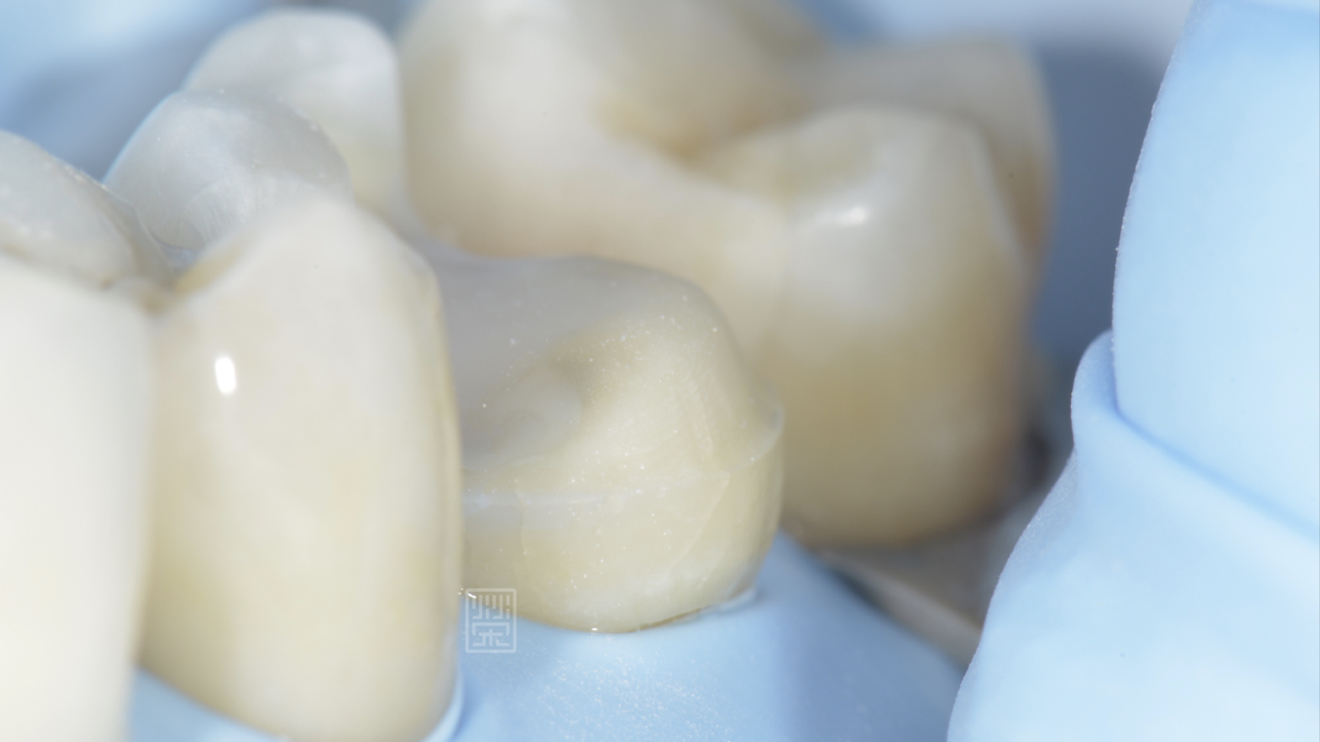 將有裂痕的牙齒包覆起來