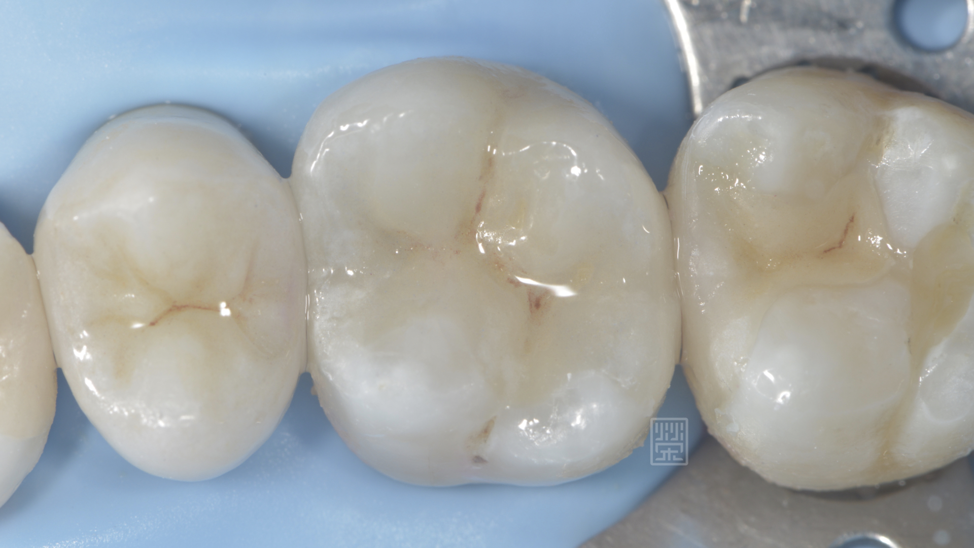 將有裂痕的牙齒包覆起來