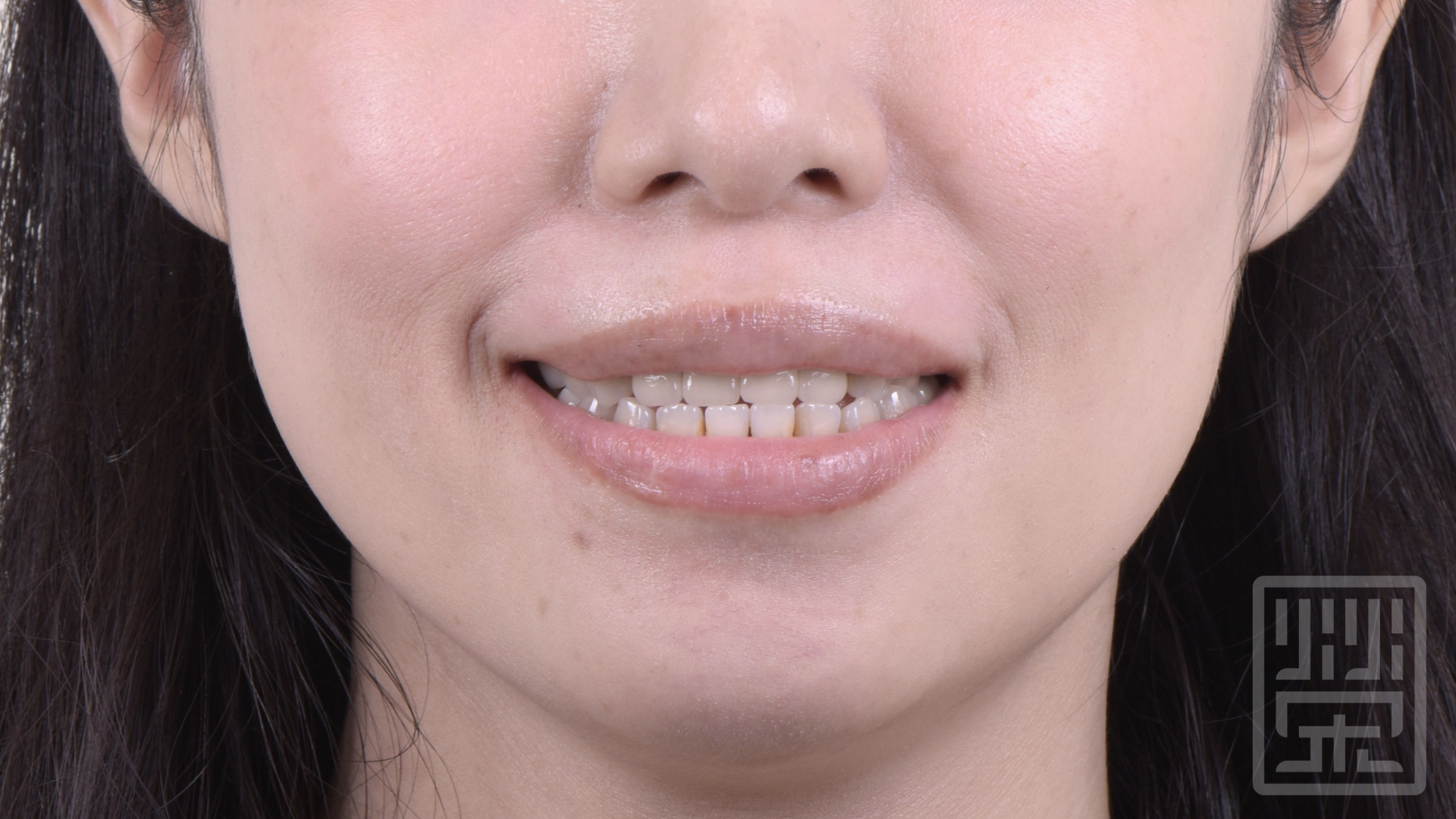 牙齒笑起來平平的，顏色黃