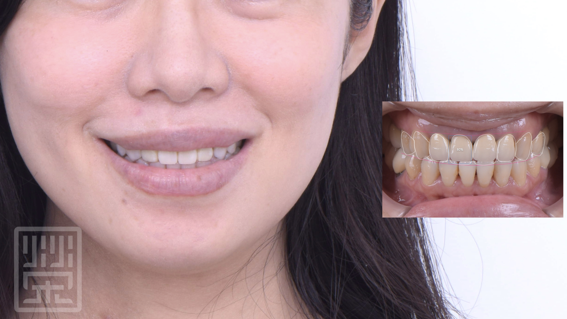 利用數位微笑模擬，將牙齒長度調整，符合微笑曲線