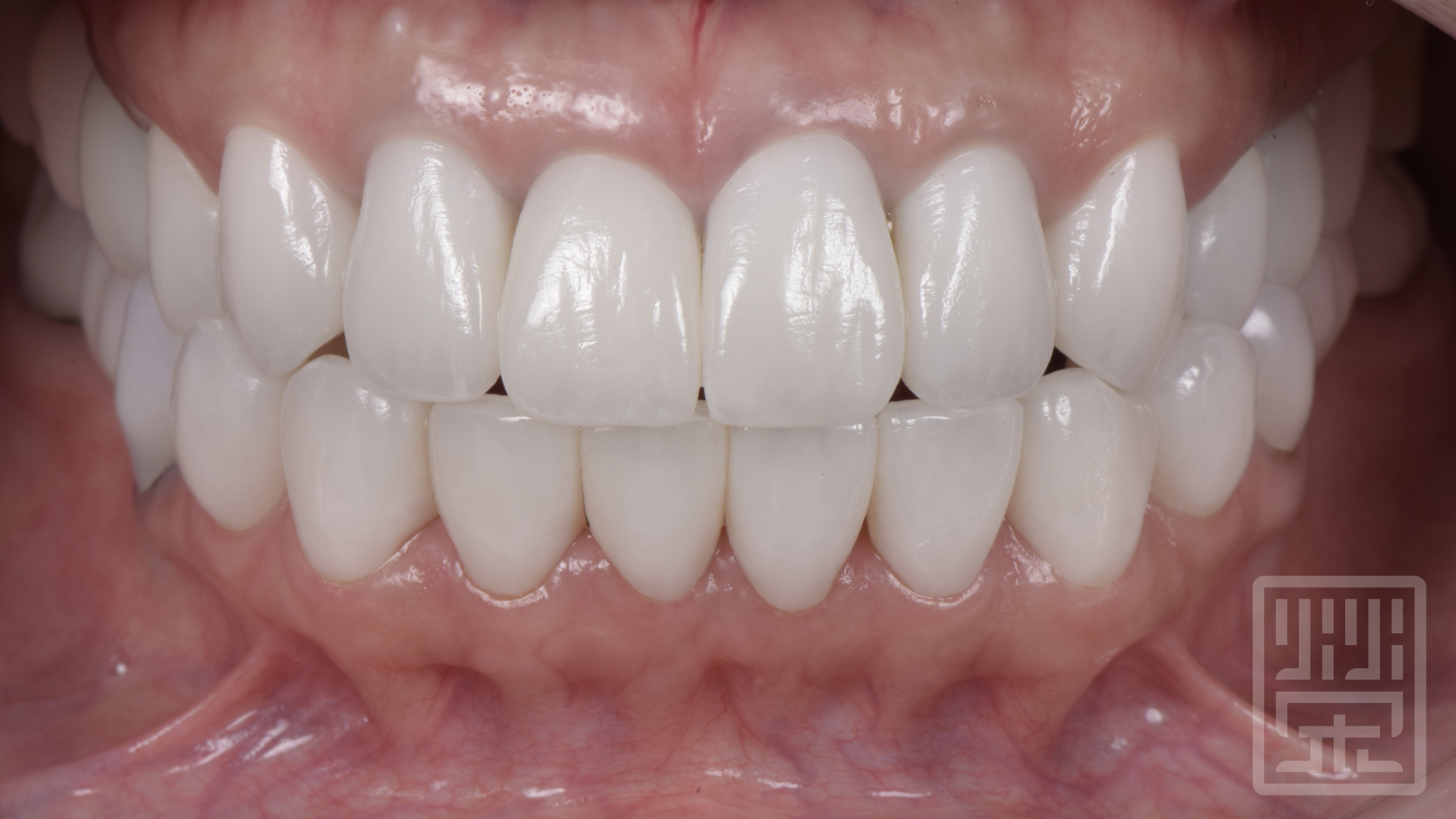 全瓷冠與貼片完成