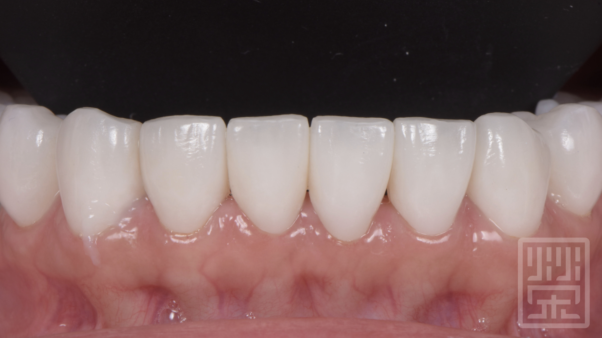 全瓷冠與貼片完成