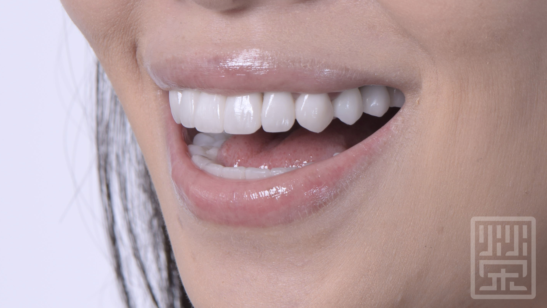 符合微笑曲線的全瓷冠排列