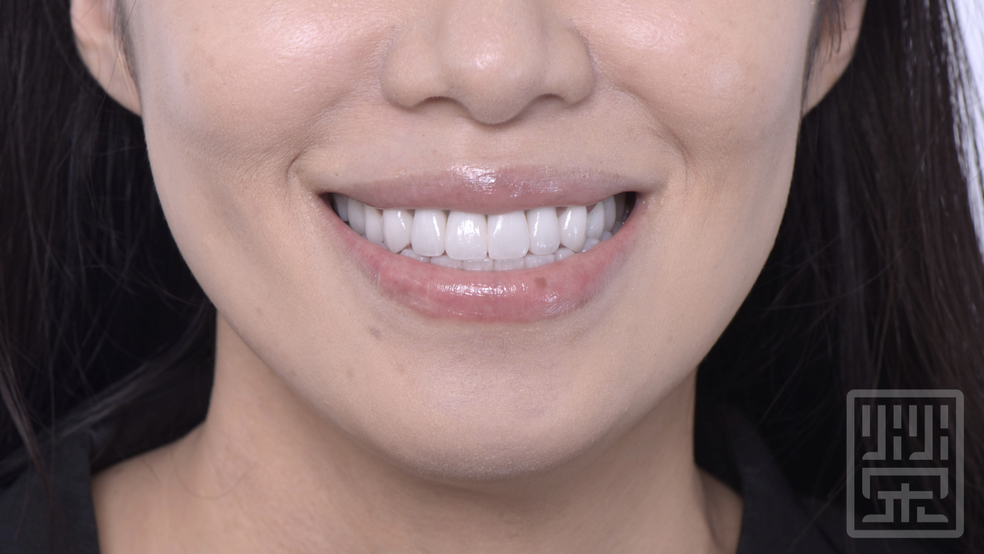 曲線的全瓷冠排列