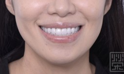 我覺得我的牙齒好黃不好看------全瓷冠貼片全口重建