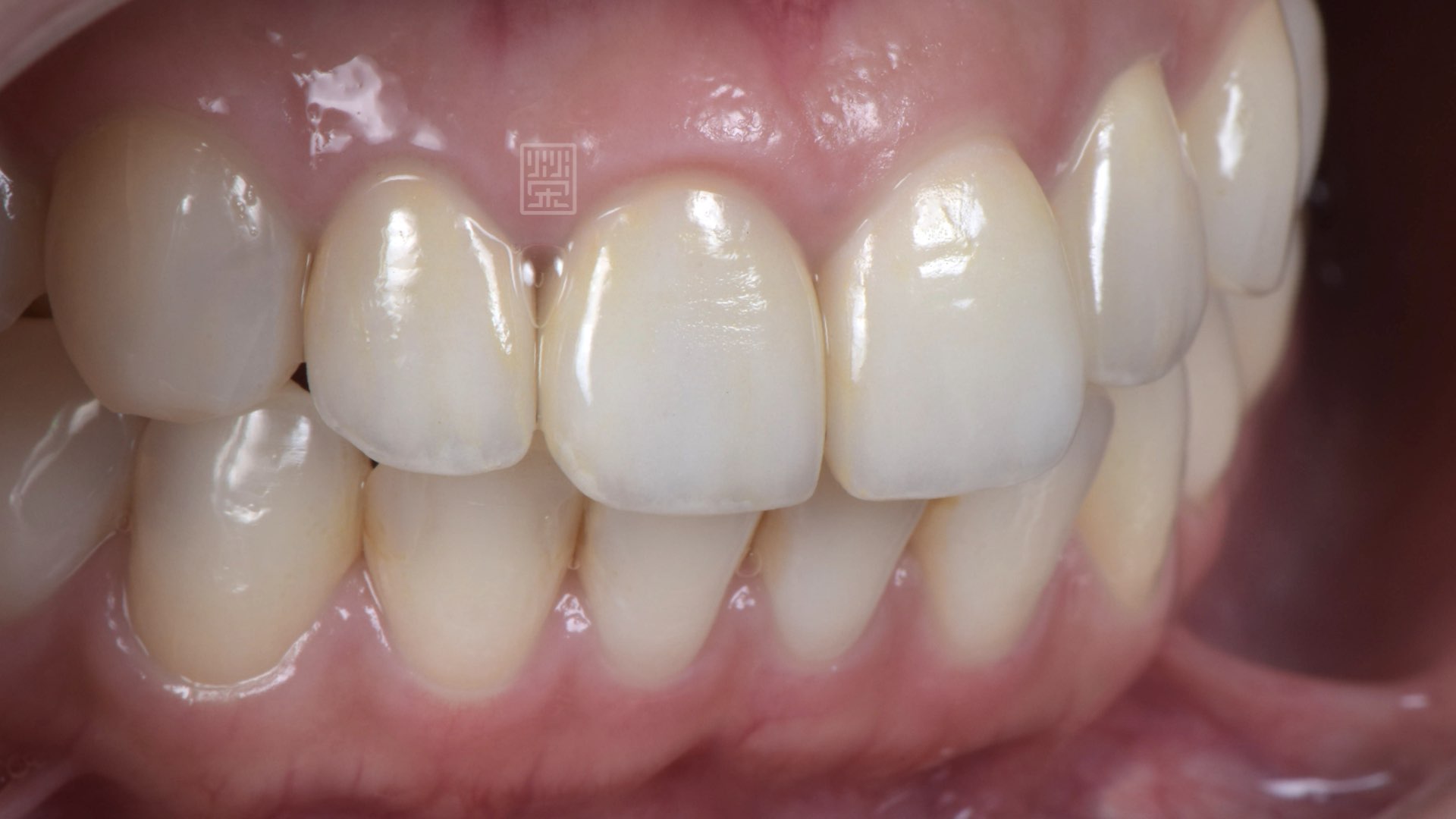 全瓷冠與貼片搭配修復