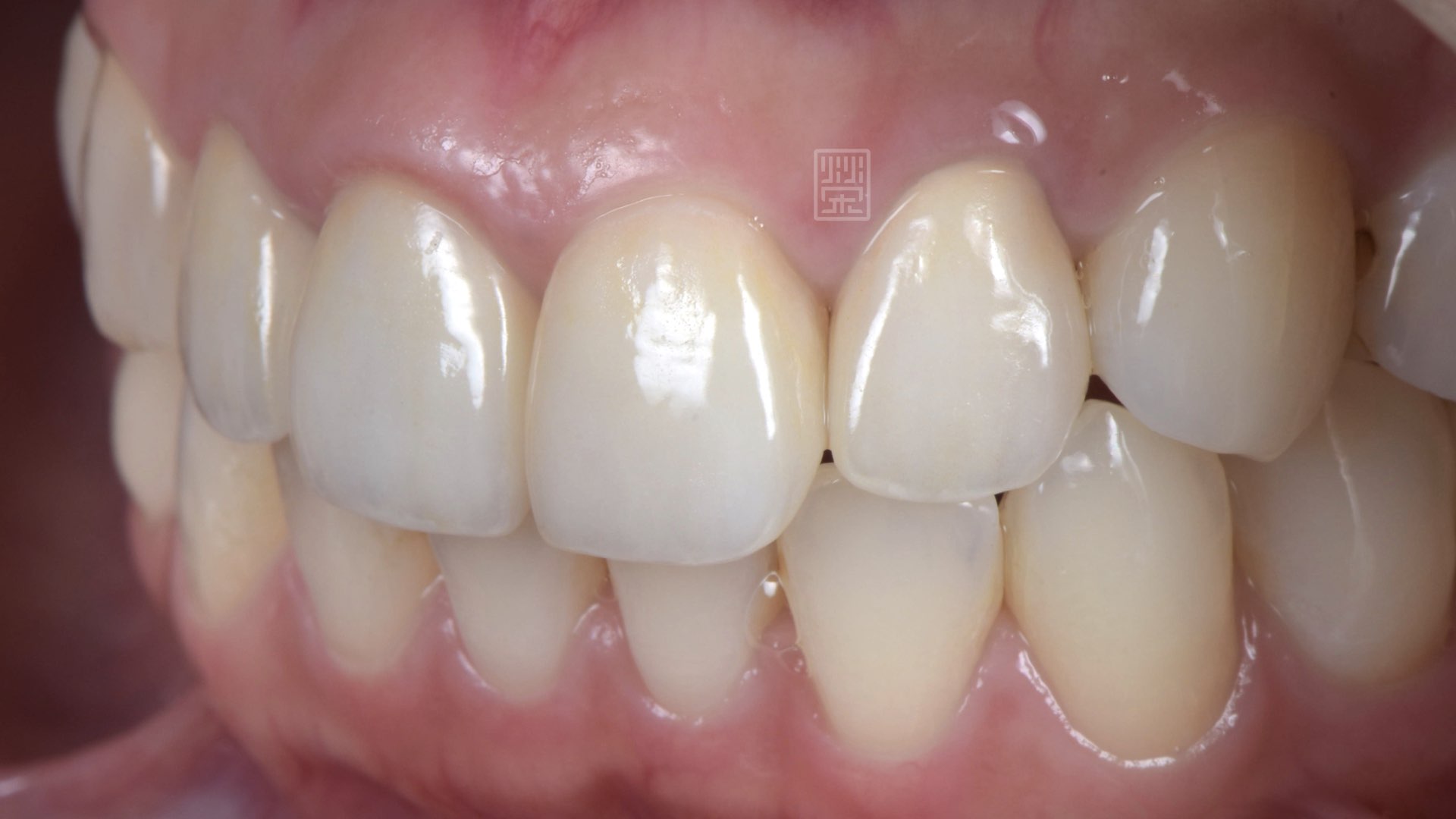 全瓷冠與貼片搭配修復