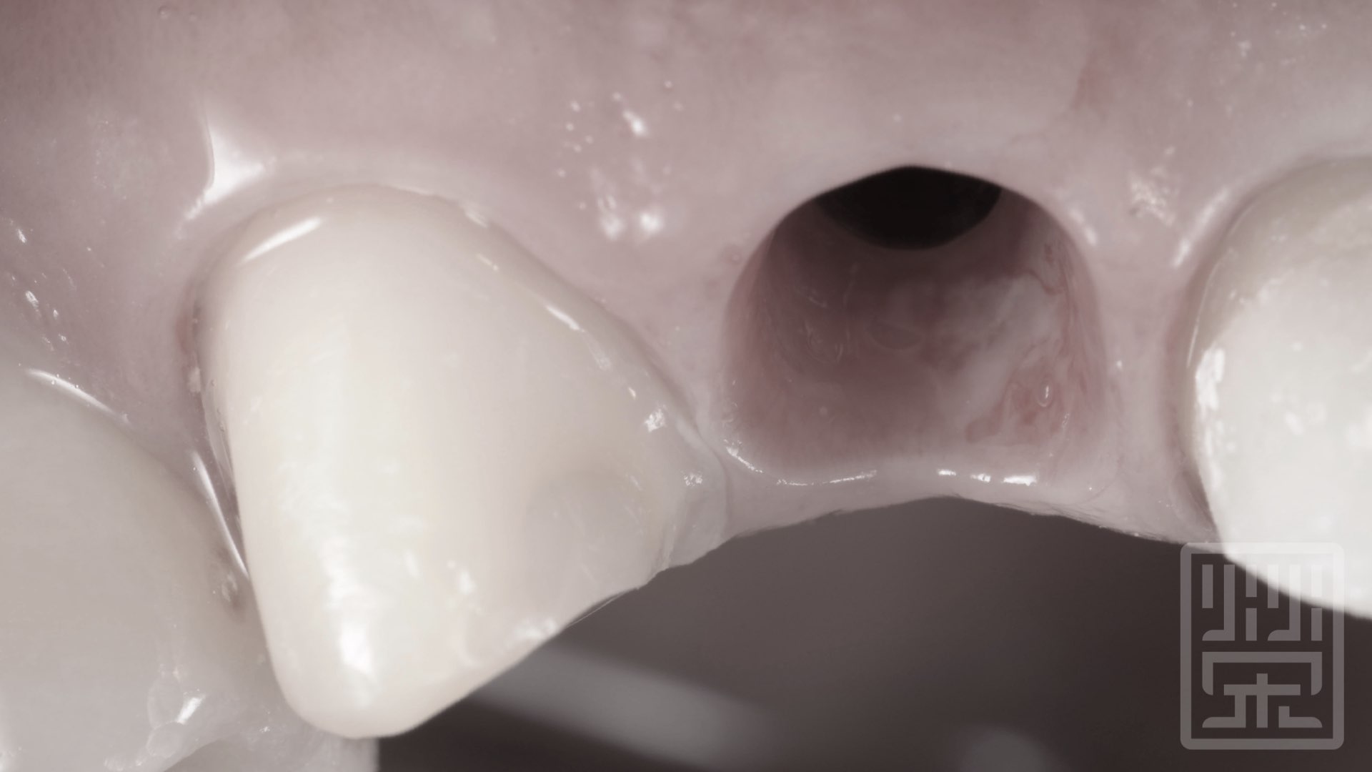 健康的植牙周圍牙齦