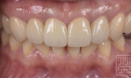 牙齒殺手，嬰兒殺———植牙全瓷冠修復