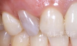 牙齒突然變黑---齒內美白