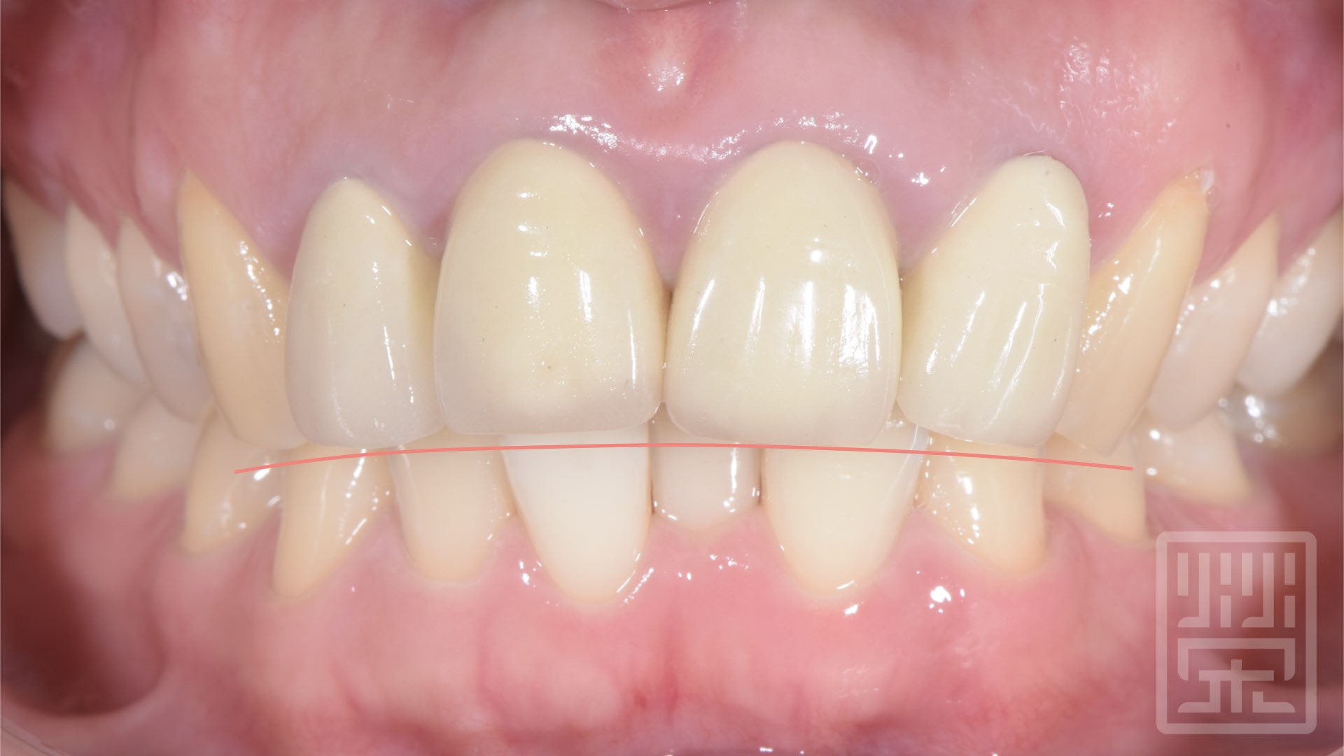 牙齒呈現反微笑曲線，呈現倒凹狀