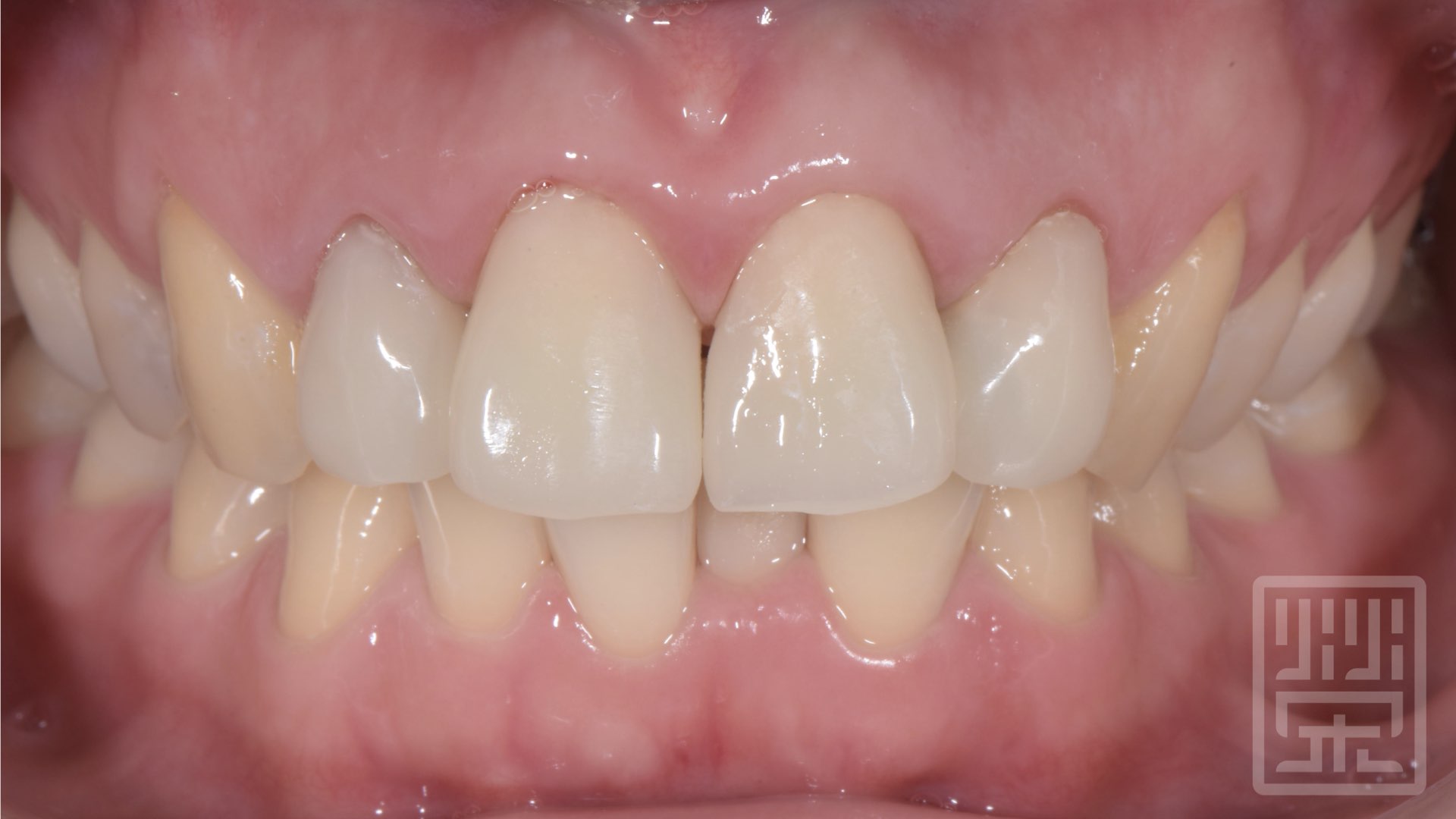 更換臨時假牙，並且模擬原先牙齒型態