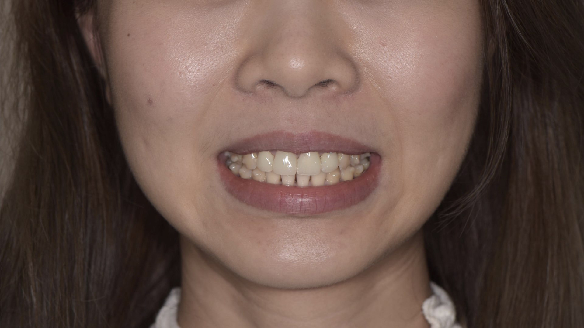 矯正後已經完成適當的微笑曲線