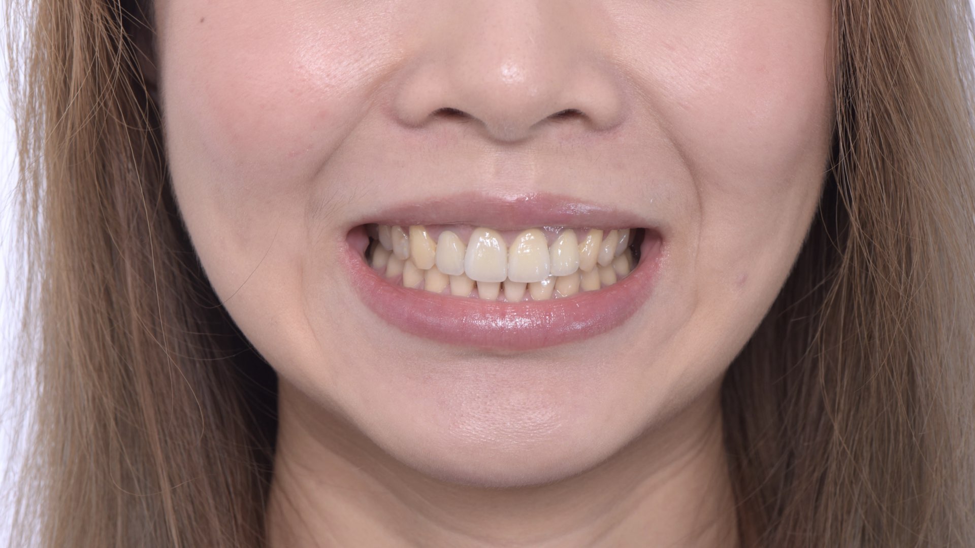 全瓷冠與微笑曲線完成