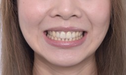 前牙笑起來像哭臉------反微笑曲線、矯正、全瓷冠