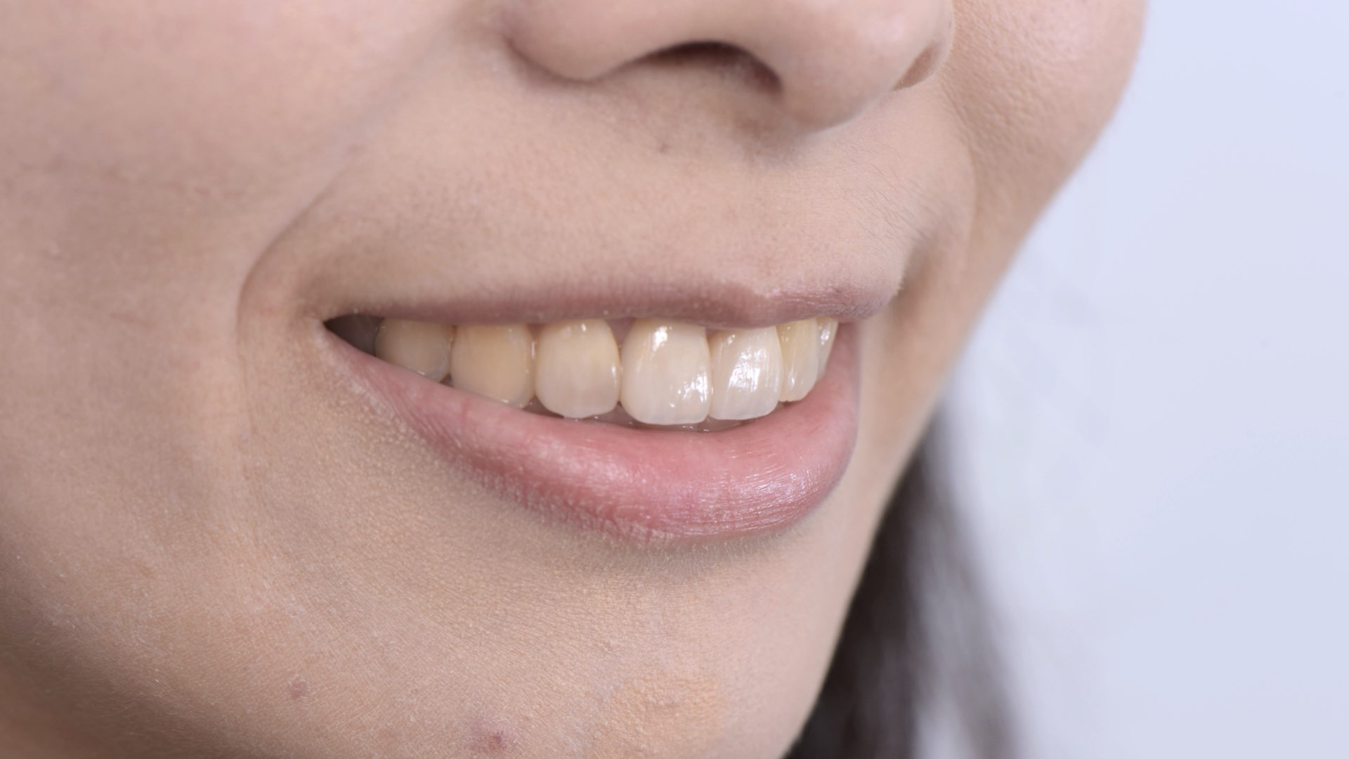 全瓷冠貼片完成