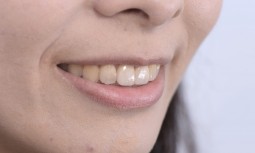 醫師，我的瓷牙冠顏色都不一樣------全瓷冠貼片修復