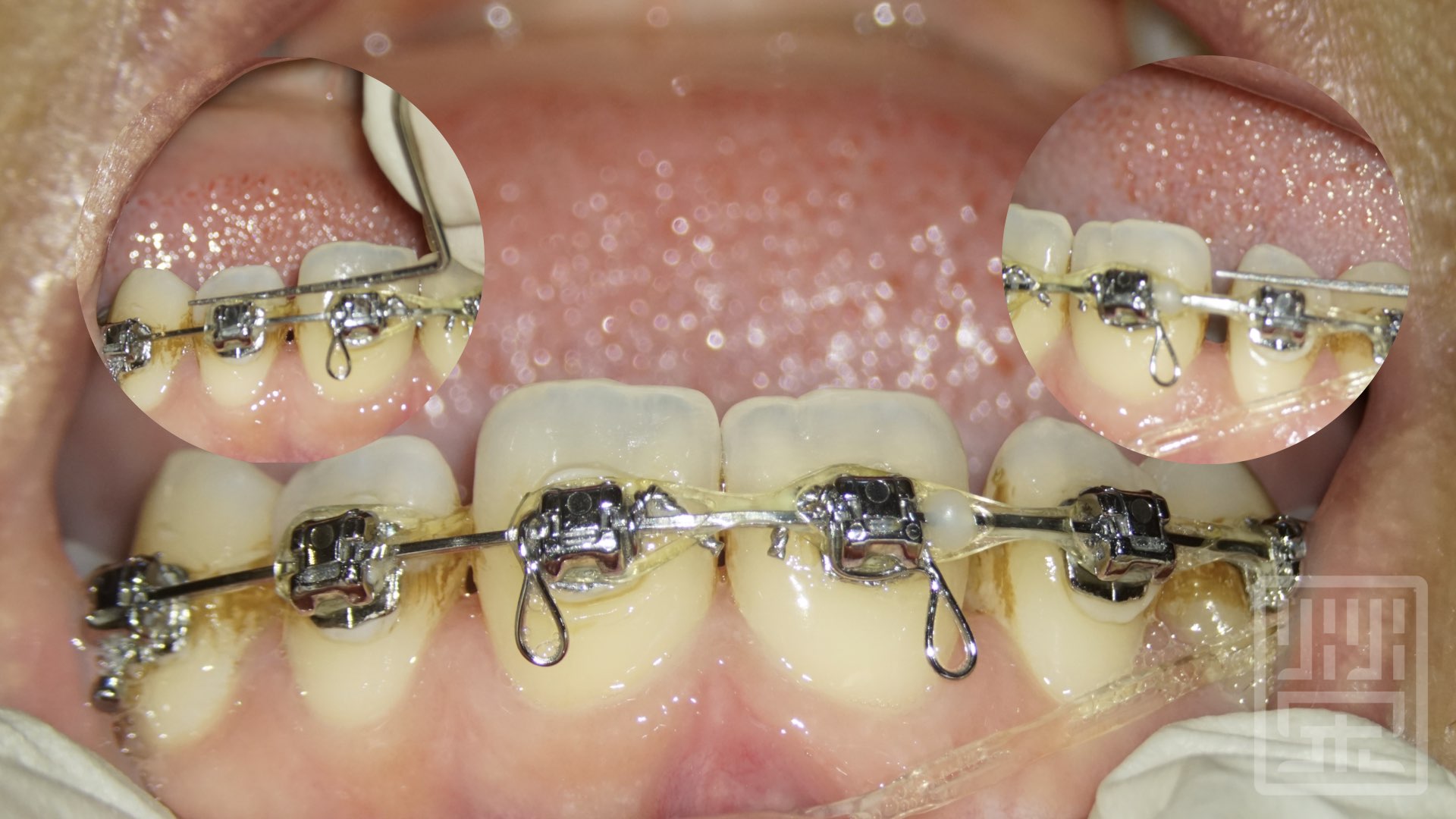 牙齒偏小，齒縫不適合關起來