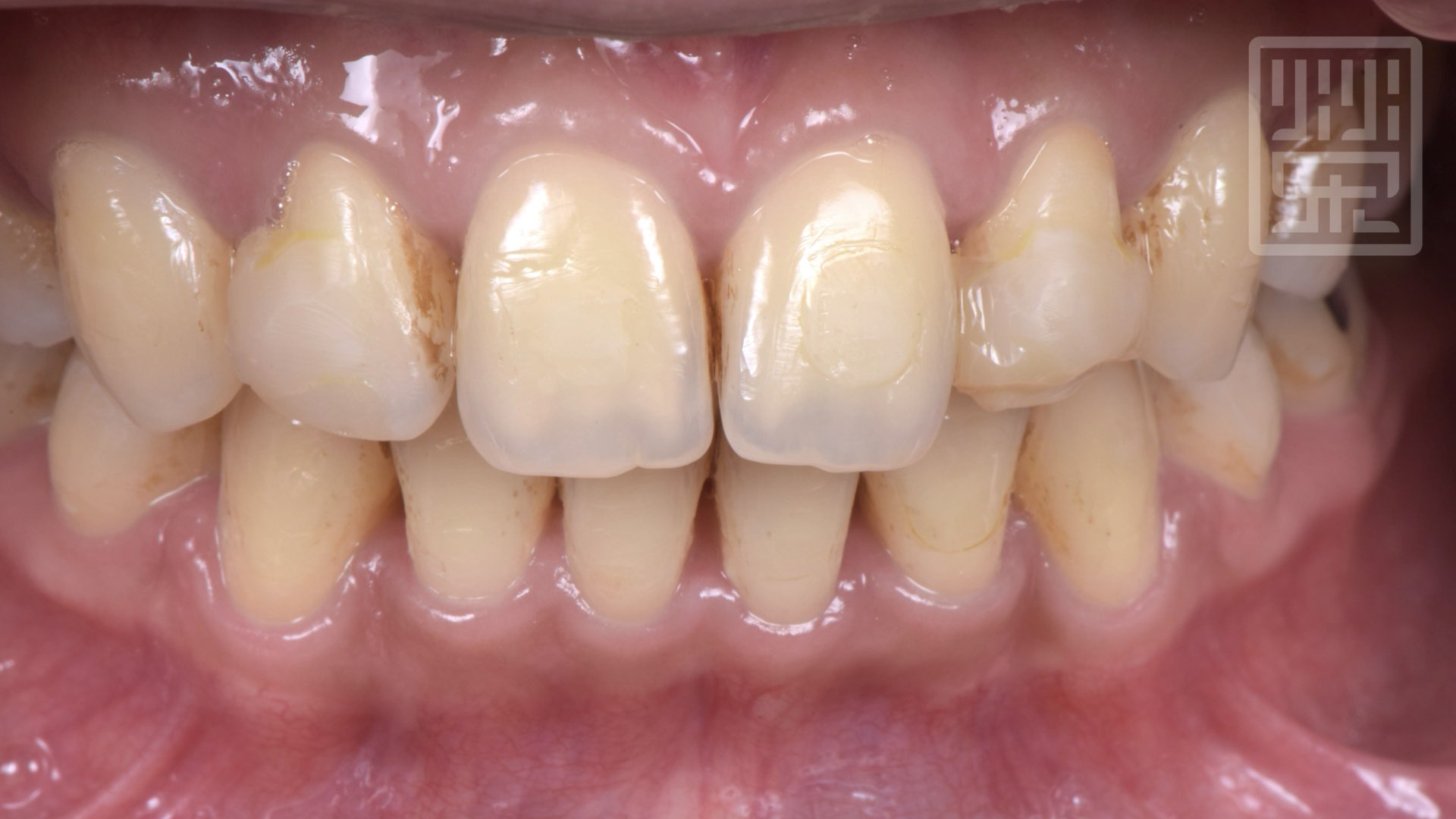 矯正後把牙縫用樹脂固定住