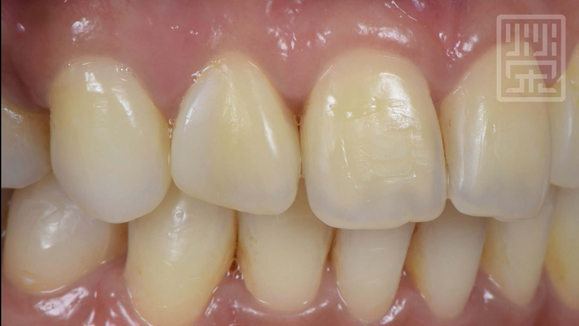 用樹脂改變牙齒型態