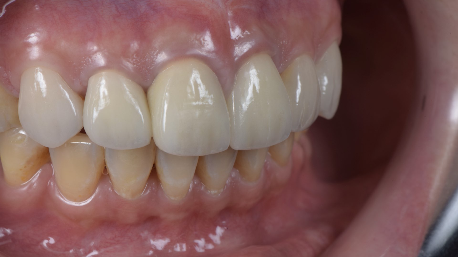 全瓷冠與貼片完成