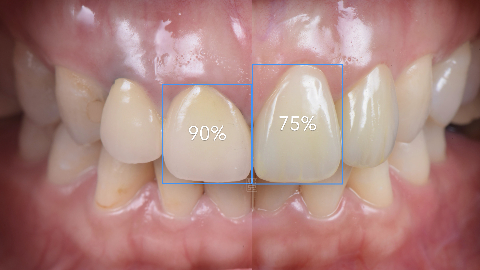 現有門牙比例是90%，依照患者的外型身高建議調整至75%