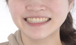 小時候車禍牙齒撞歪了，而且還把一顆牙齒撞沒了------矯正、植牙合併全瓷冠修復