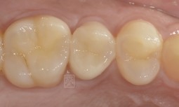 牙齒偶爾覺得酸酸的，原來蛀了那麼大一個洞------ＭＴＡ（三氧礦化物）保護牙髓，再用陶瓷嵌體恢復牙齒結構