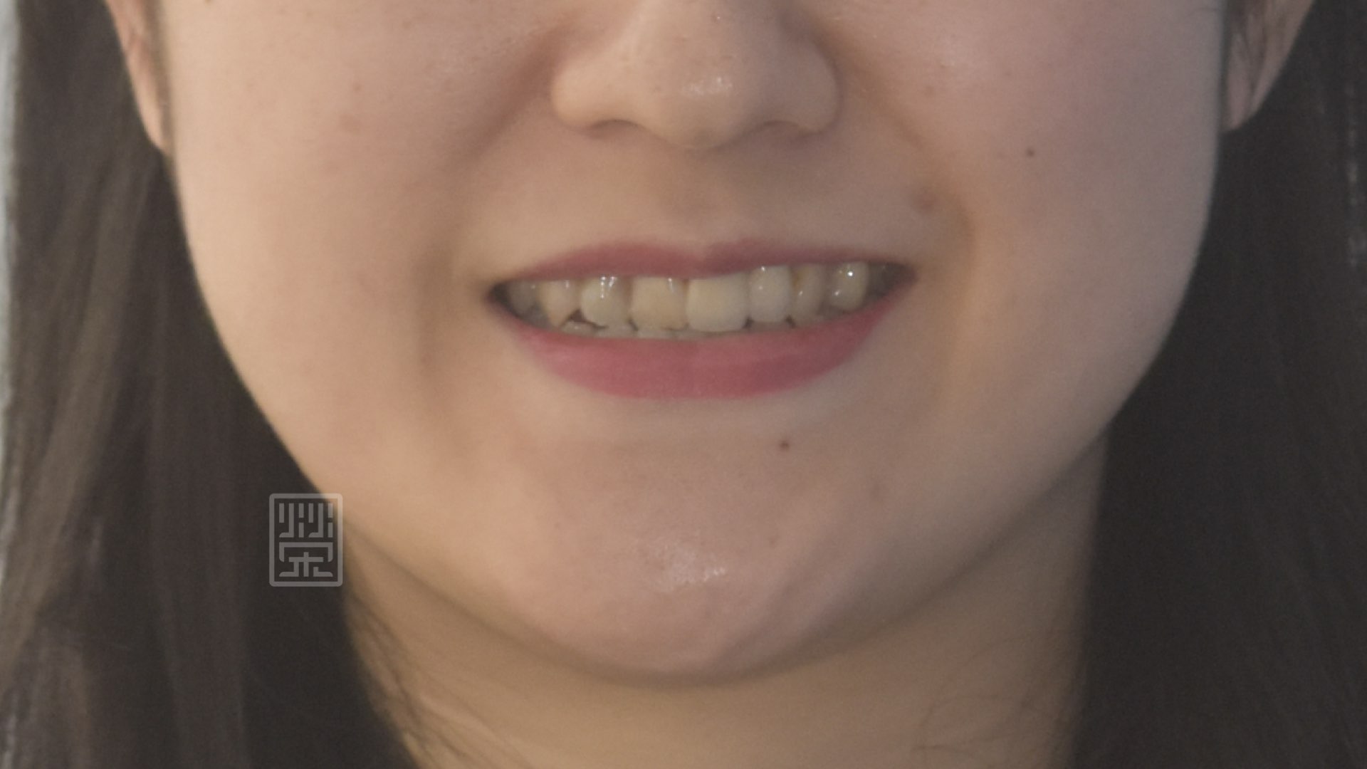 矯正前牙齒錯咬