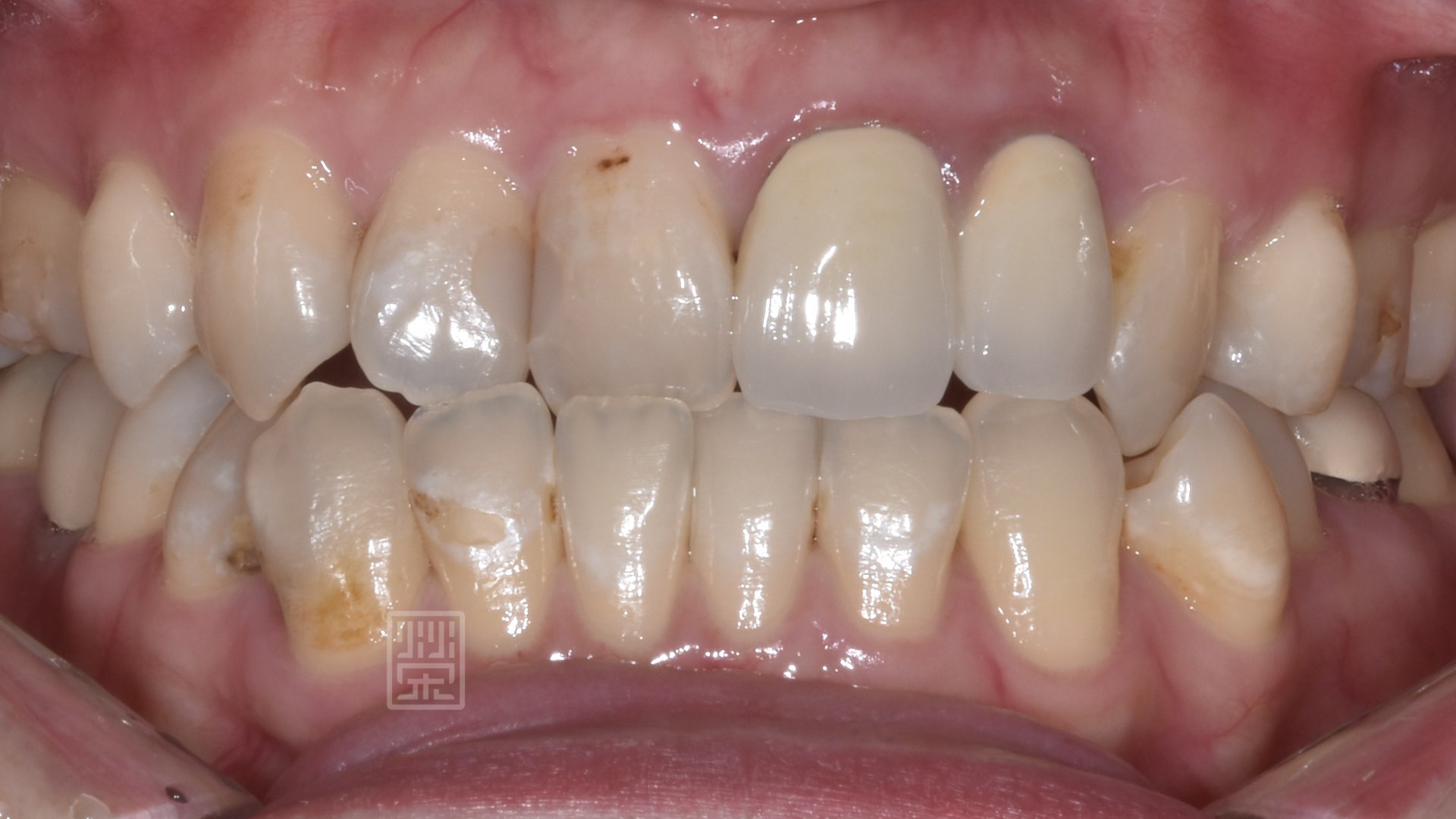 矯正前牙齒錯咬