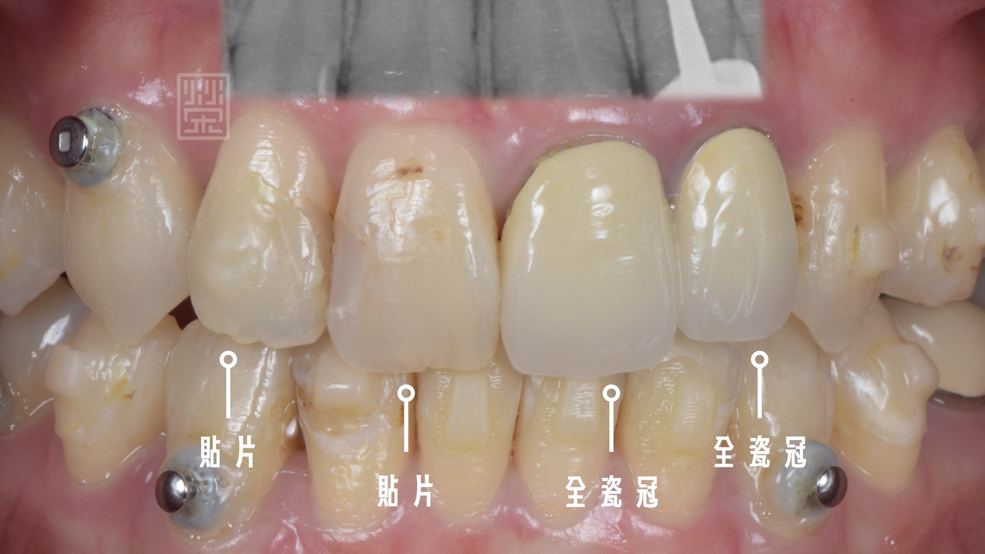 利用全瓷冠與貼片修復