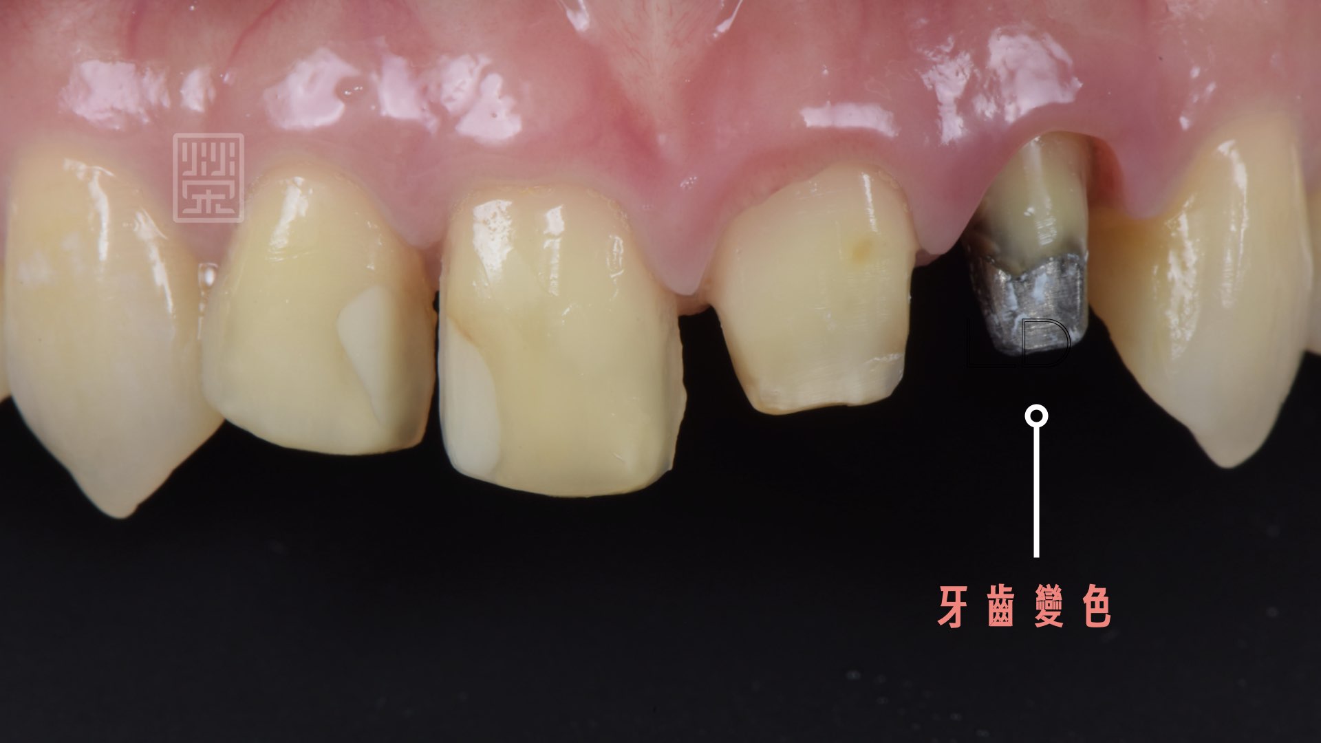 側門牙因為金屬牙釘牙齒整嚴重變色