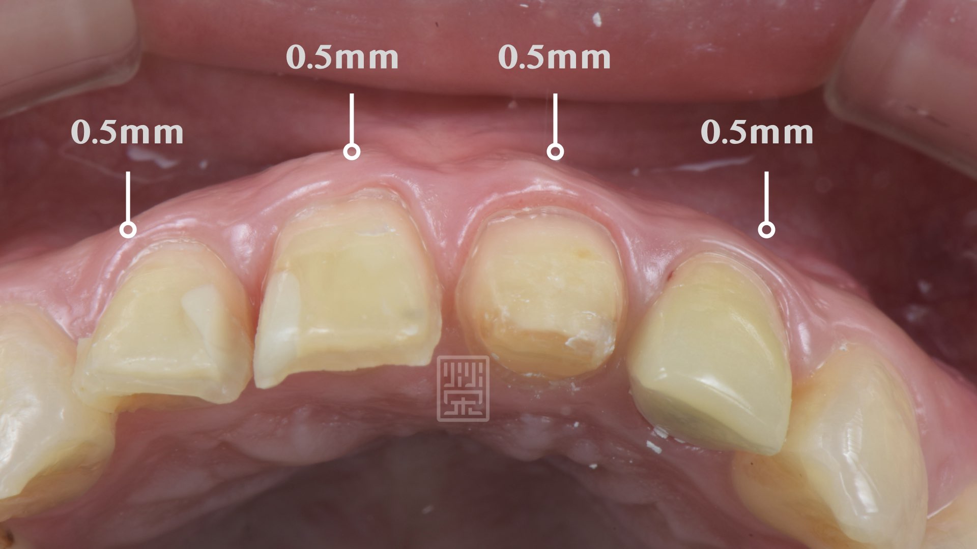 內層全瓷冠遮色