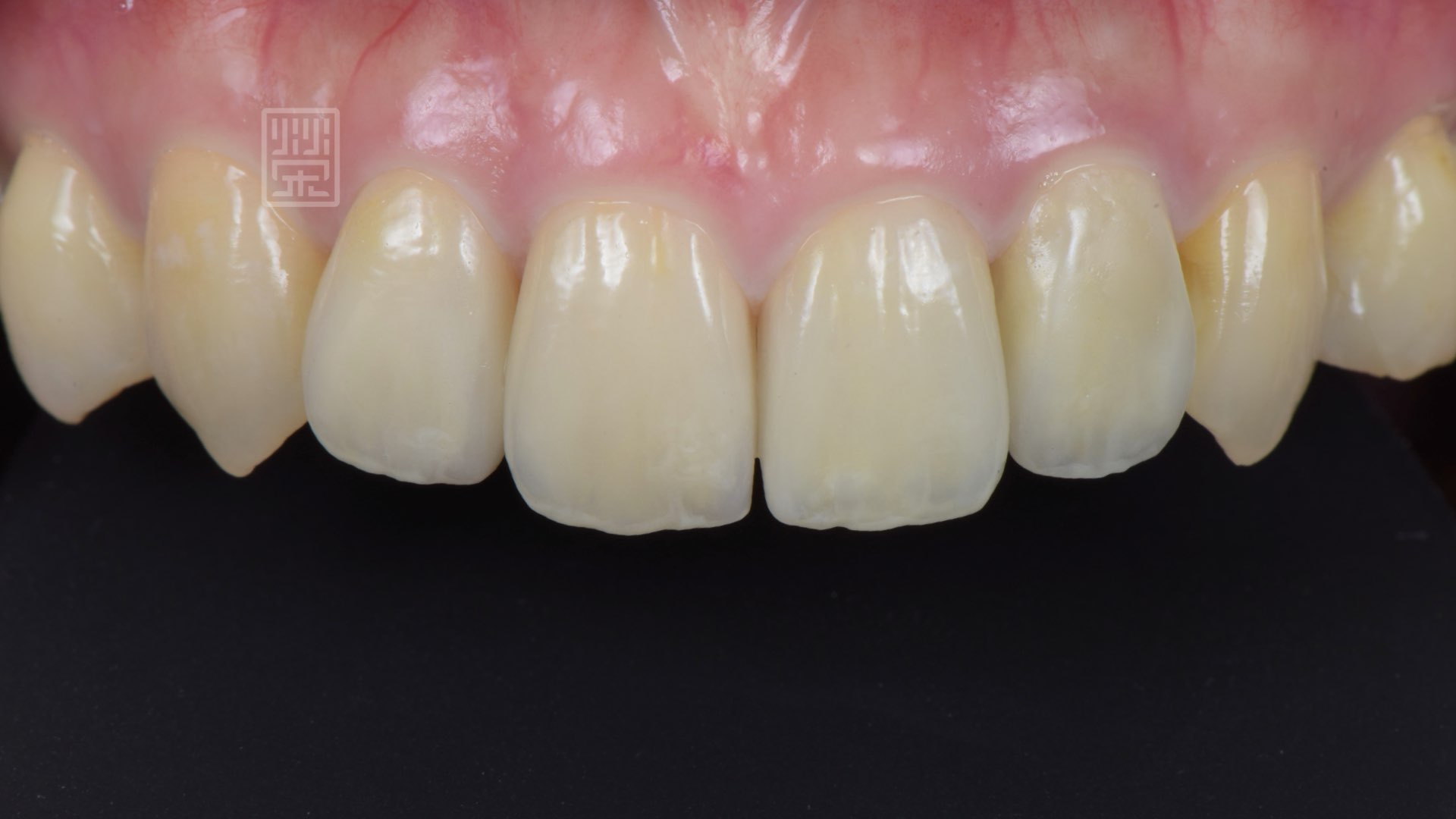 全瓷冠貼片完成