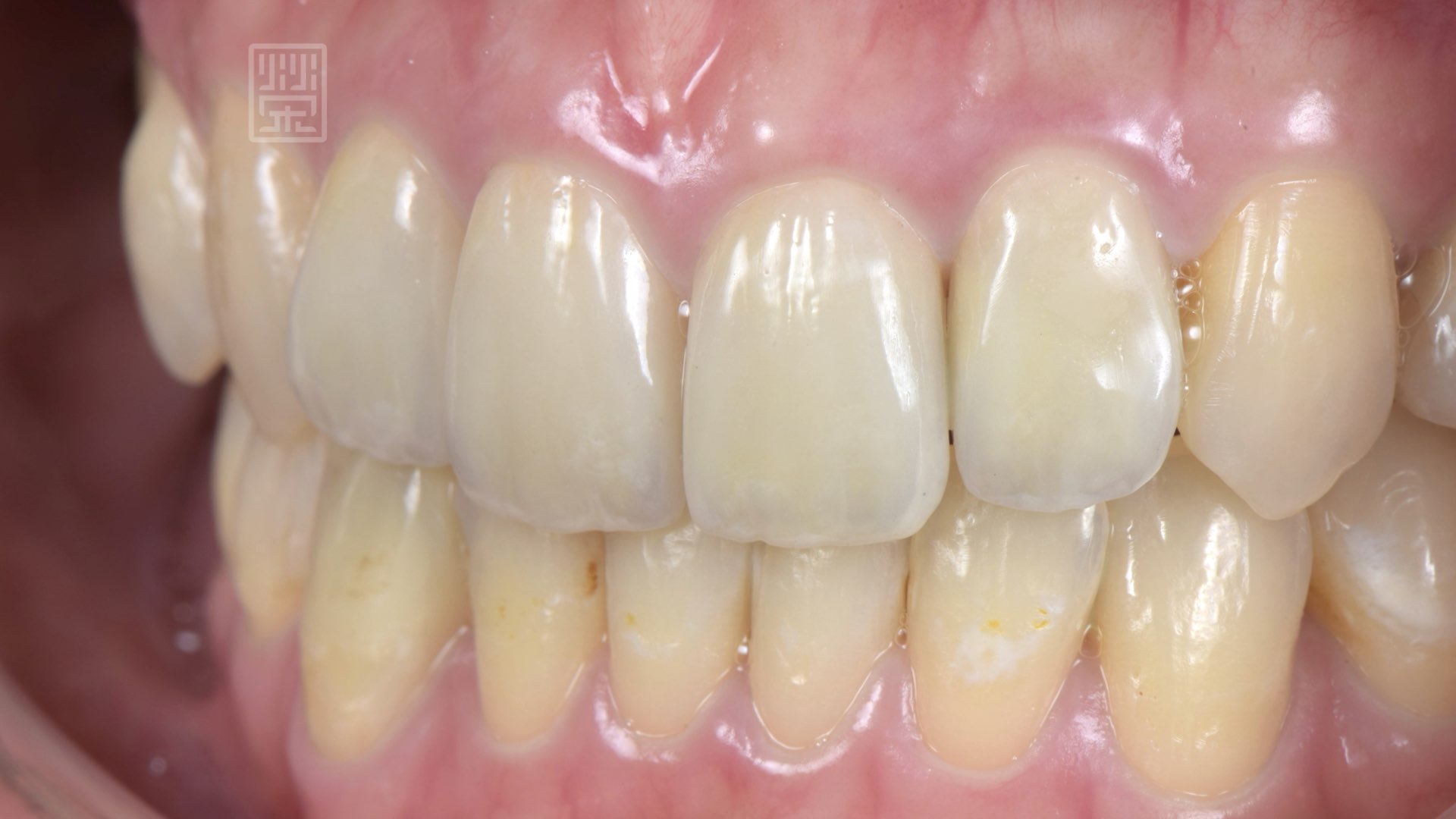 網全瓷冠貼片完成